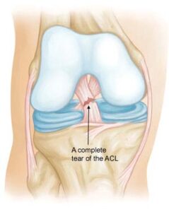 Austin Ortho Wellness - ACL Tear